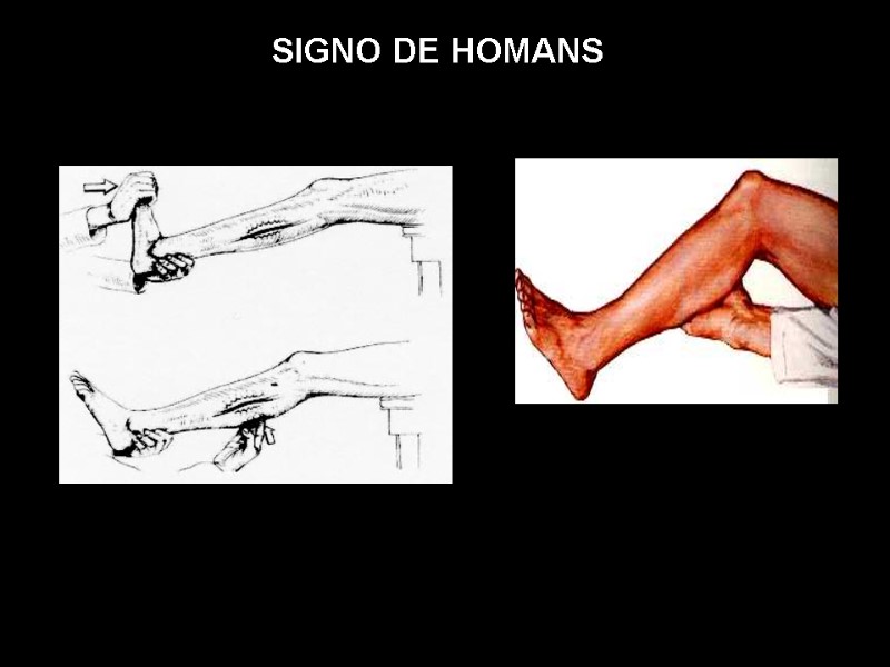 SIGNO DE HOMANS